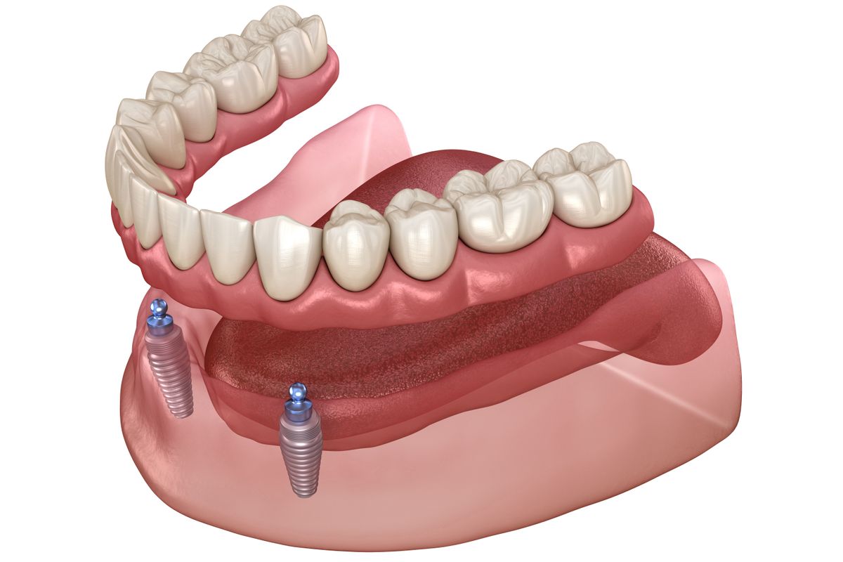 Implant Retained Denture featured image