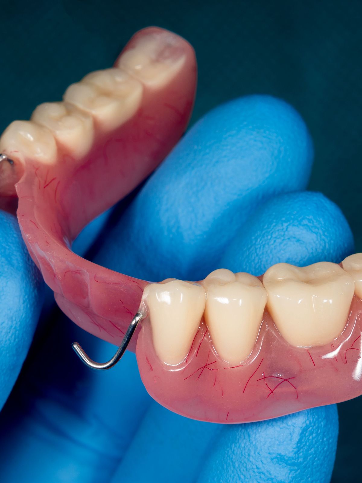 Acrylic Partial Denture featured image